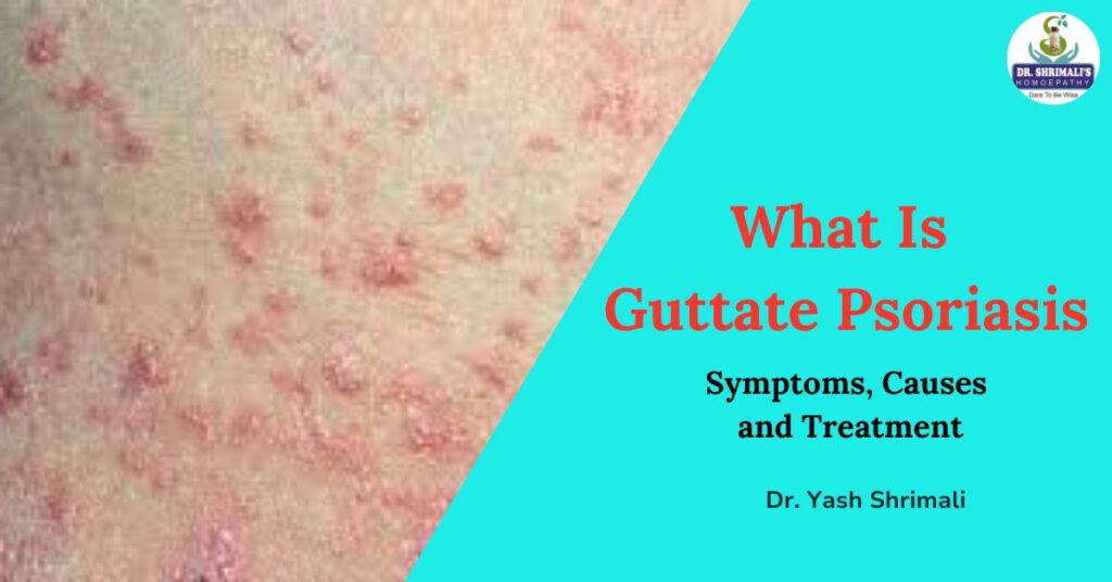 Best Homeopathy Treatment For Guttate Psoriasis Symptoms, Causes