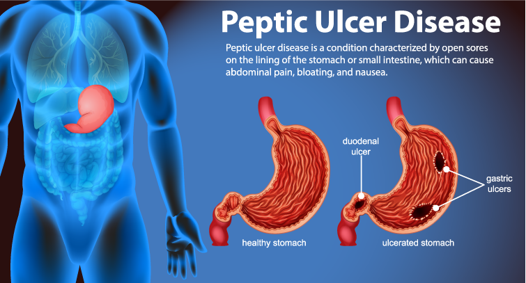 Peptic Ulcer Treatment Homeopathic Remedies And Symptoms